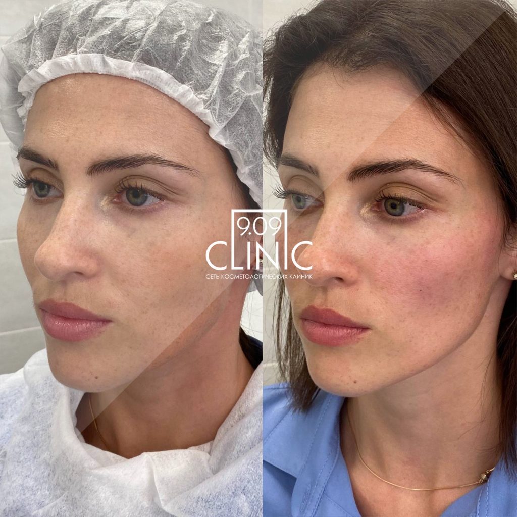 Пластика Скул Филлерами Фото До И После — New-Freepik.Ru